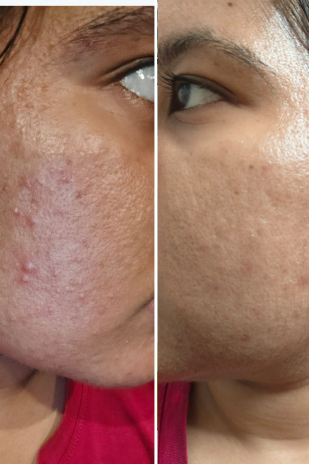 Close-up of skin during a dermatology consultation for acne scars and pigmentation